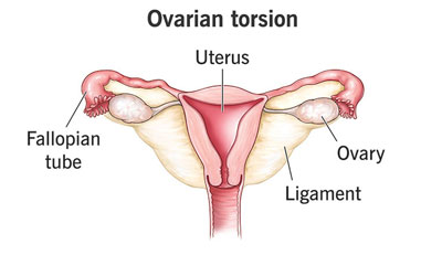 Ovarian Torsion