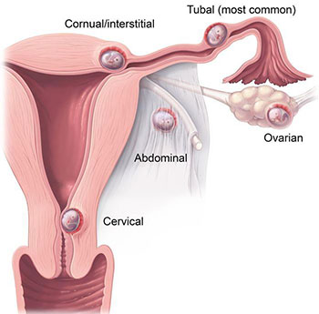 Ectopic Pregnancy