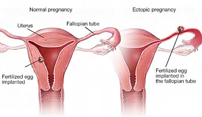 Ectopic Pregnancy