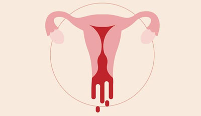 Heavy Menstrual Bleeding