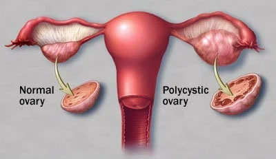 PCOS