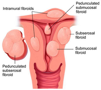 Fibroids