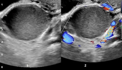 Endometriosis Diagnosis