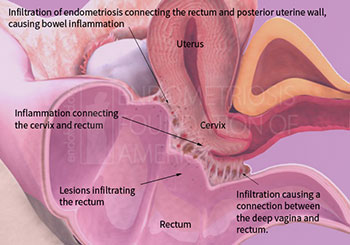 Bowel Endometriosis