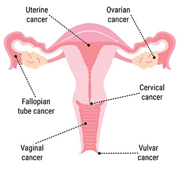Gynecologic Cancer