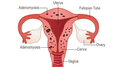 Adenomyosis