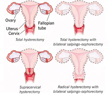 Hysterectomy