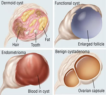 Ovarian Cyst