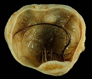 Dermoid Cyst